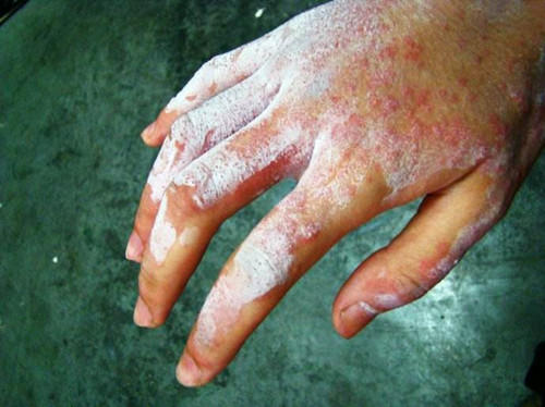 高锰酸钾灼伤皮肤表现图片
